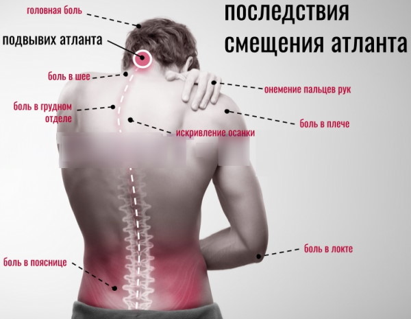 Подвывих шейного позвонка у ребенка. Симптомы, последствия