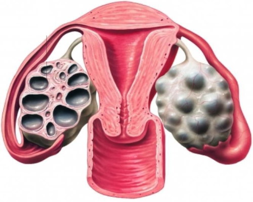 Поликистоз яичников. Симптомы и причины возникновения