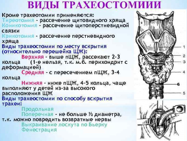 Трахеостомия: набор инструментов, техника выполнения, виды