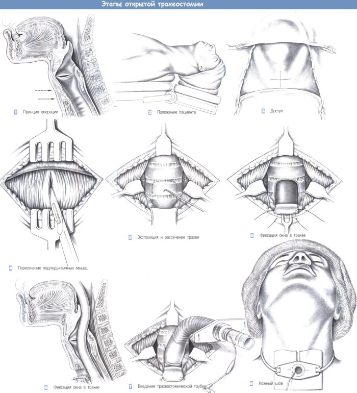 Трахеостомия: набор инструментов, техника выполнения, виды