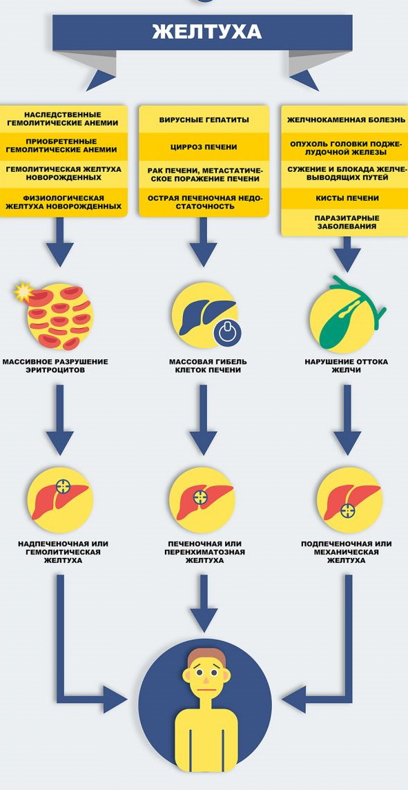 Желтуха у взрослых. Причины, симптомы, лечение, последствия
