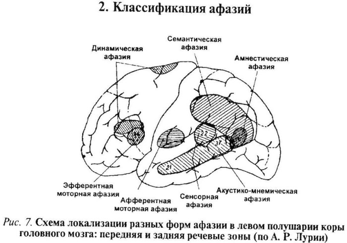 Афазия в логопедии. Что это такое, определение нарушения речи