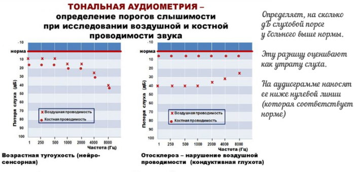 Аудиограмма слуха. Расшифровка, таблица, норма