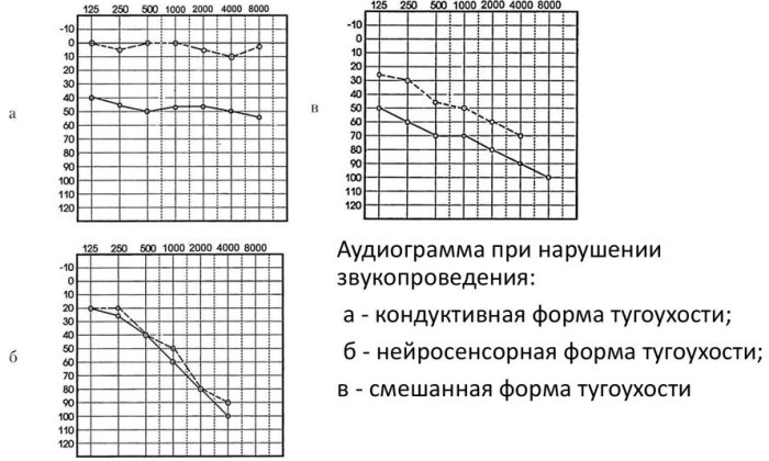 Аудиограмма слуха. Расшифровка, таблица, норма