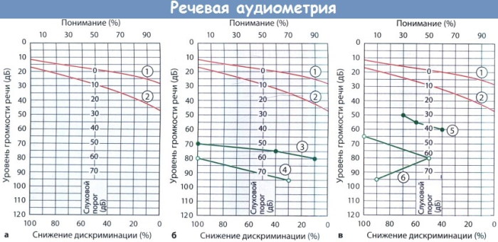 Аудиограмма слуха. Расшифровка, таблица, норма