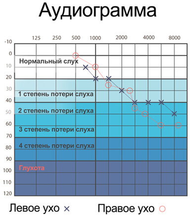 Аудиограмма слуха. Расшифровка, таблица, норма