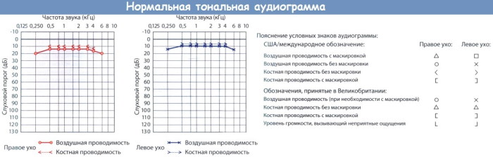 Аудиограмма слуха. Расшифровка, таблица, норма