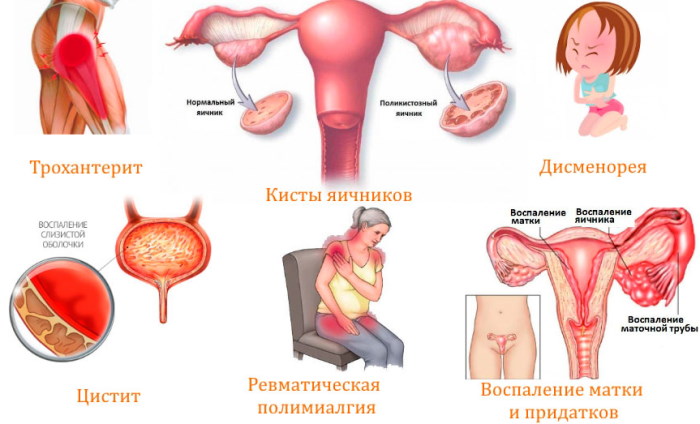 Болит поясница слева сзади у женщин, отдает в ногу