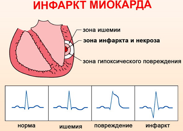 Инфаркт миокарда: что делать, первая помощь