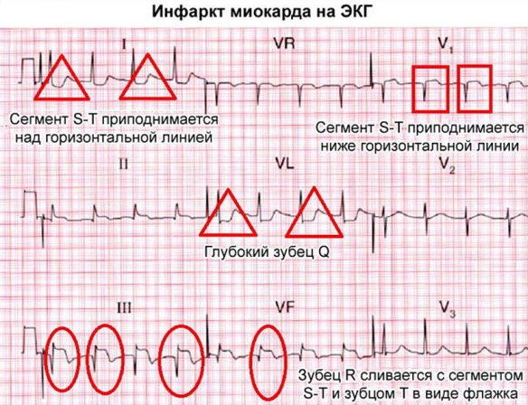 Инфаркт миокарда: что делать, первая помощь