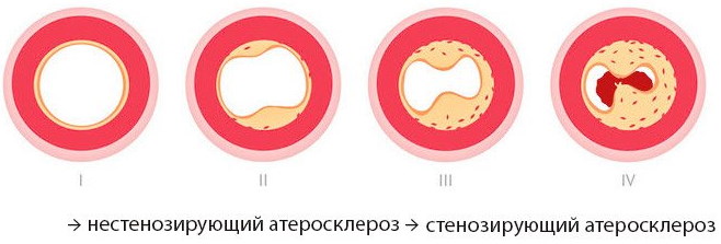 Нестенозирующий атеросклероз БЦА (брахиоцефальных артерий)