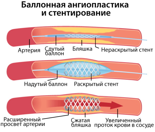 Нестенозирующий атеросклероз БЦА (брахиоцефальных артерий)