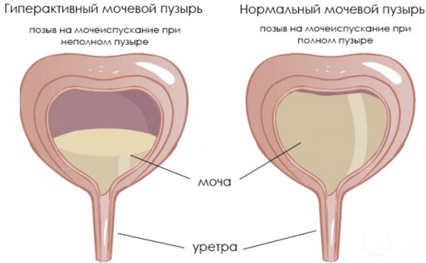 Объем мочевого пузыря человека мужчин, женщин. Норма