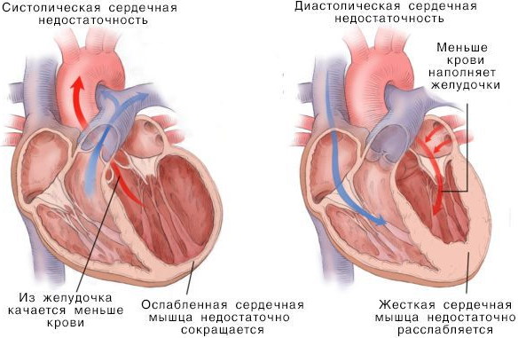 Острая левожелудочковая недостаточность. Что это, симптомы, причины