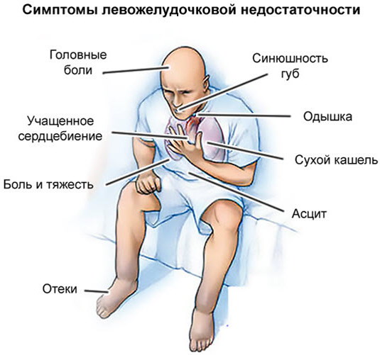 Острая левожелудочковая недостаточность. Что это, симптомы, причины