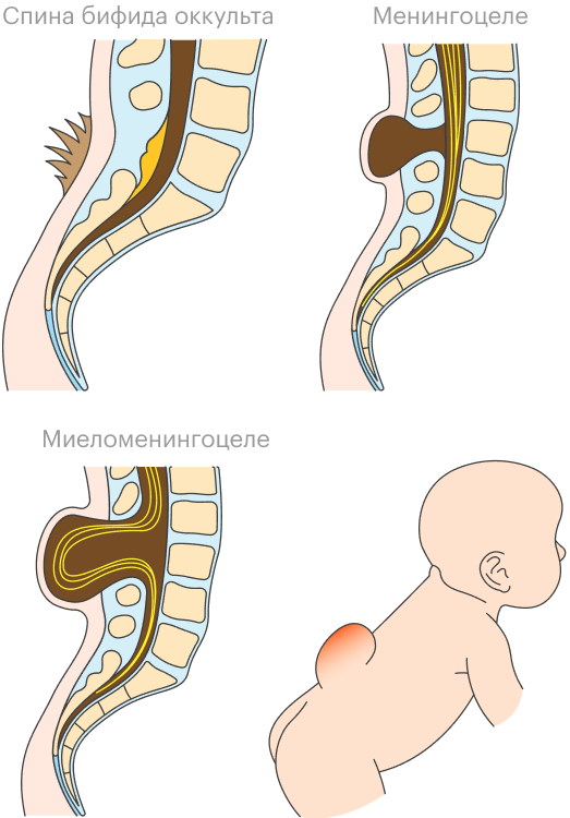 Спина бифида (spina bifida) S1 у взрослых. Лечение, что это значит