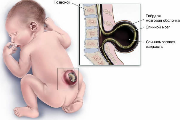 Спина бифида (spina bifida) S1 у взрослых. Лечение, что это значит