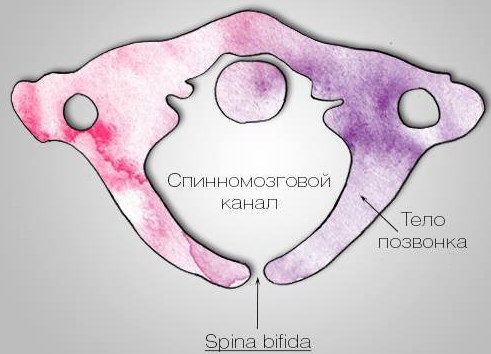 Спина бифида (spina bifida) S1 у взрослых. Лечение, что это значит