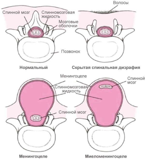 Спина бифида (spina bifida) S1 у взрослых. Лечение, что это значит