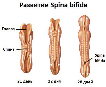 Спина бифида (spina bifida) S1 у взрослых. Лечение, что это значит