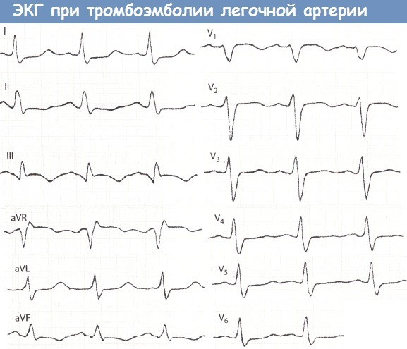 ТЭЛА на ЭКГ. Признаки, фото, что это, лечение