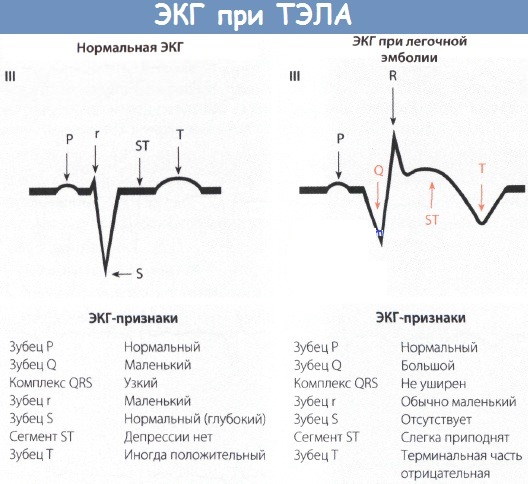 ТЭЛА на ЭКГ. Признаки, фото, что это, лечение