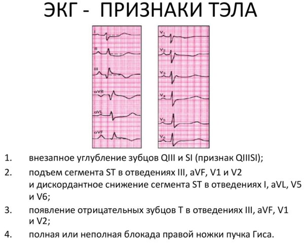 ТЭЛА на ЭКГ. Признаки, фото, что это, лечение