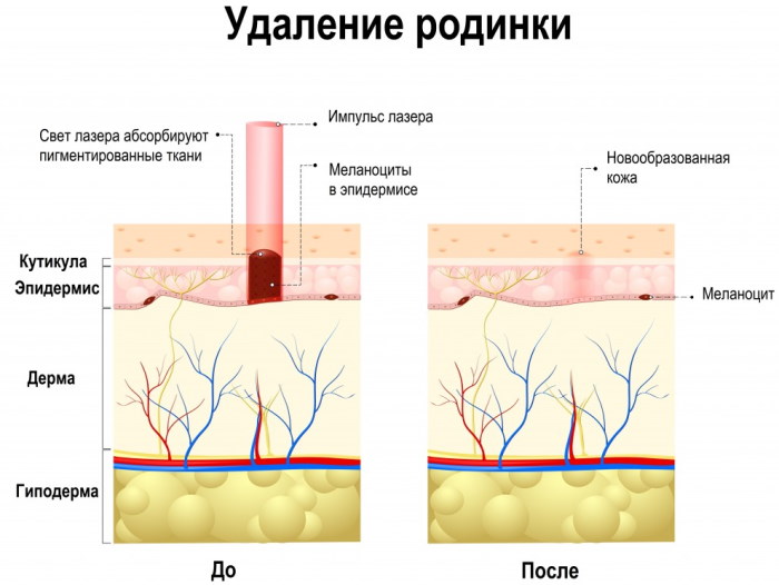 Удаление родинок лазером. Цена, отзывы