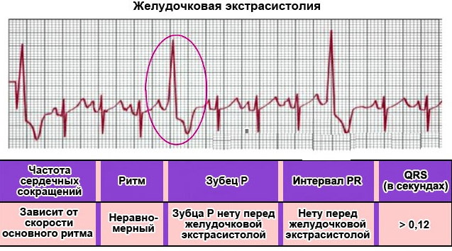 Желудочковая экстрасистолия на ЭКГ: признаки, расшифровка