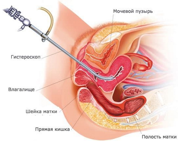 Анэхогенное содержимое. Включения в шейке матки, что это