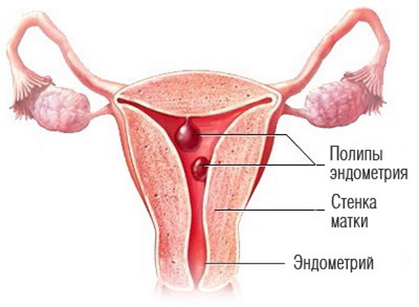 Анэхогенное содержимое. Включения в шейке матки, что это