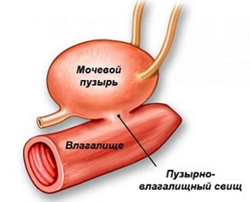 Фистулография свища. Что это такое, как проводится