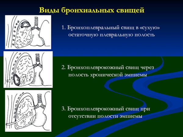 Фистулография свища. Что это такое, как проводится