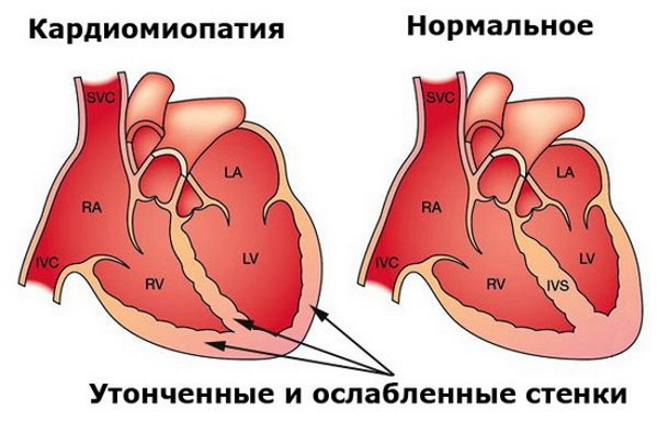 Фракция выброса сердца. Норма у взрослых, что покажет УЗИ