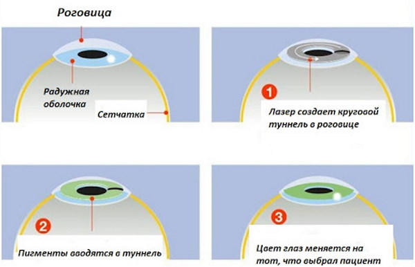 Гетерохромия глаз у людей. Фото, причины, что означает