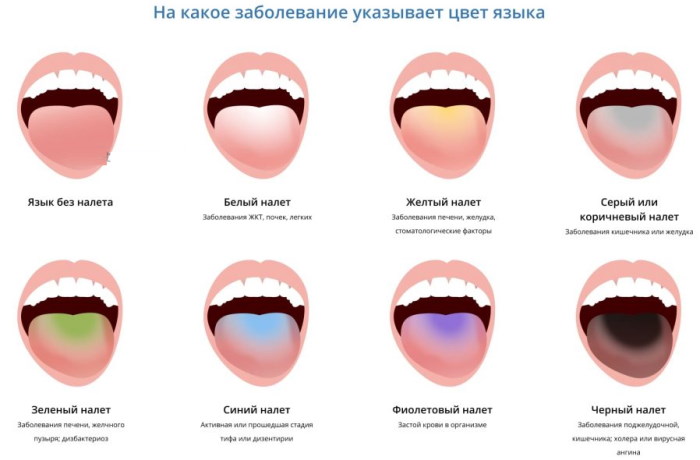 Как по языку определить заболевание: цвет, схема, симптомы