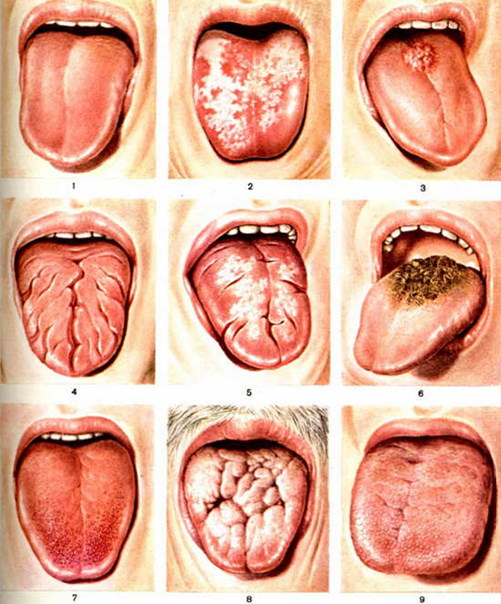 Как по языку определить заболевание: цвет, схема, симптомы