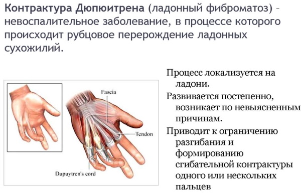 Контрактура Дюпюитрена. Что это, лечение мышц, суставов