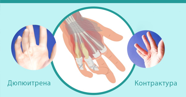 Контрактура Дюпюитрена. Что это, лечение мышц, суставов