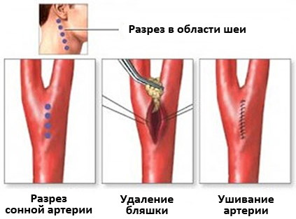 Наружная сонная артерия и ее ветви: схема, анатомия, кровоснабжение