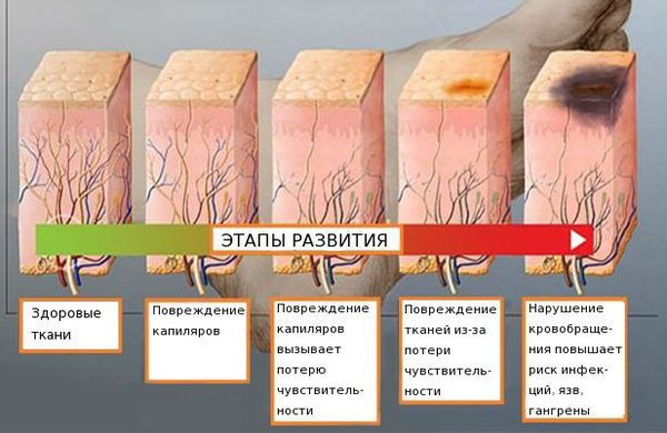 Нейропатия. Что это такое, симптомы, как лечить