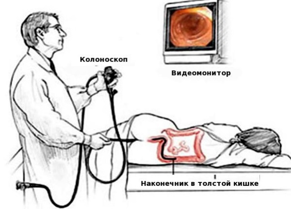 Серонегативный спондилоартрит. Что это такое, симптомы, лечение