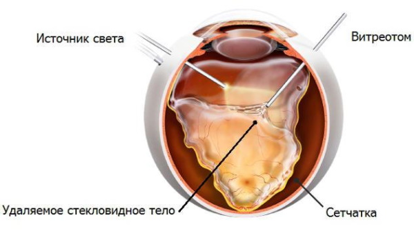 Стекловидное тело глаза: отслоение. Что это, симптомы, лечение