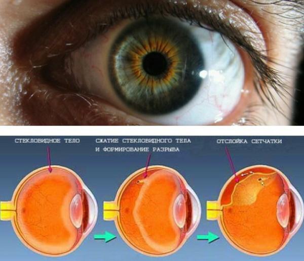 Стекловидное тело глаза: отслоение. Что это, симптомы, лечение