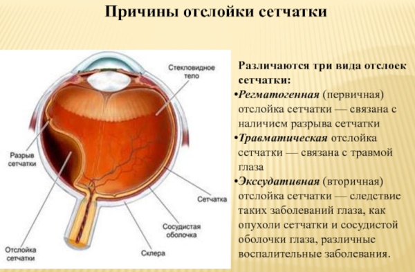 Стекловидное тело глаза: отслоение. Что это, симптомы, лечение