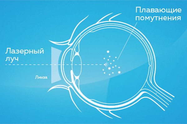 Стекловидное тело глаза: отслоение. Что это, симптомы, лечение