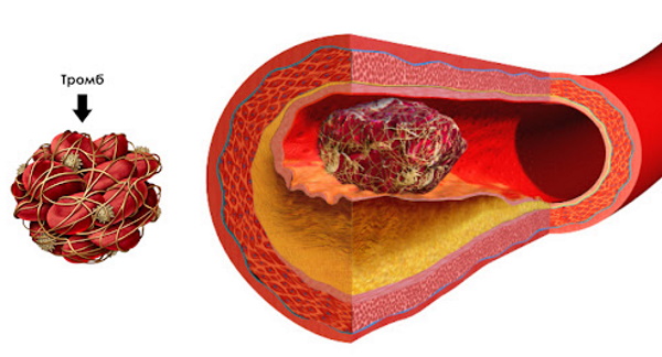 Тромб в сердце. Симптомы, лечение, что делать, причины