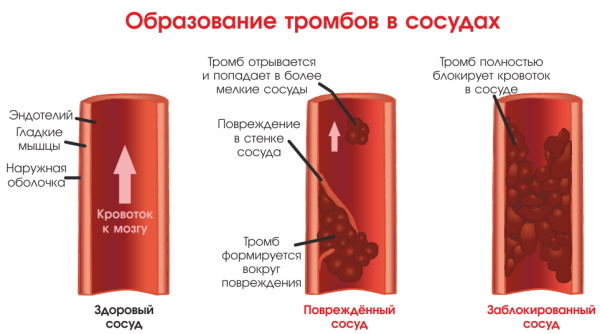 Тромб в сердце. Симптомы, лечение, что делать, причины