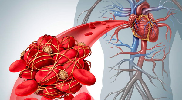 Тромб в сердце. Симптомы, лечение, что делать, причины