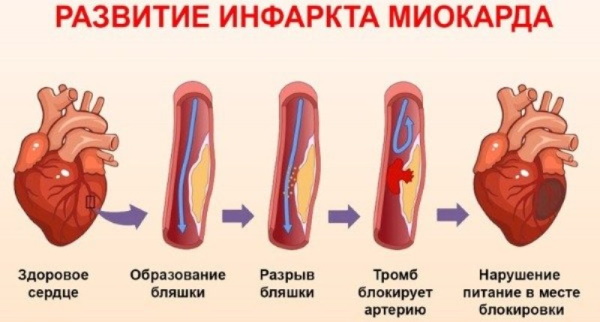 Тромб в сердце. Симптомы, лечение, что делать, причины